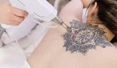 The Ultimate Guide to Tattoo Removal in 2026