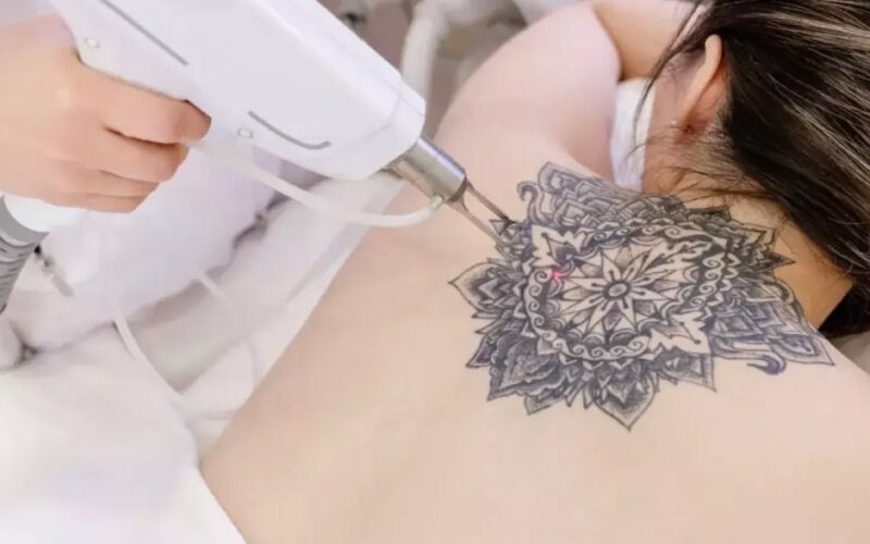 The Ultimate Guide to Tattoo Removal in 2026