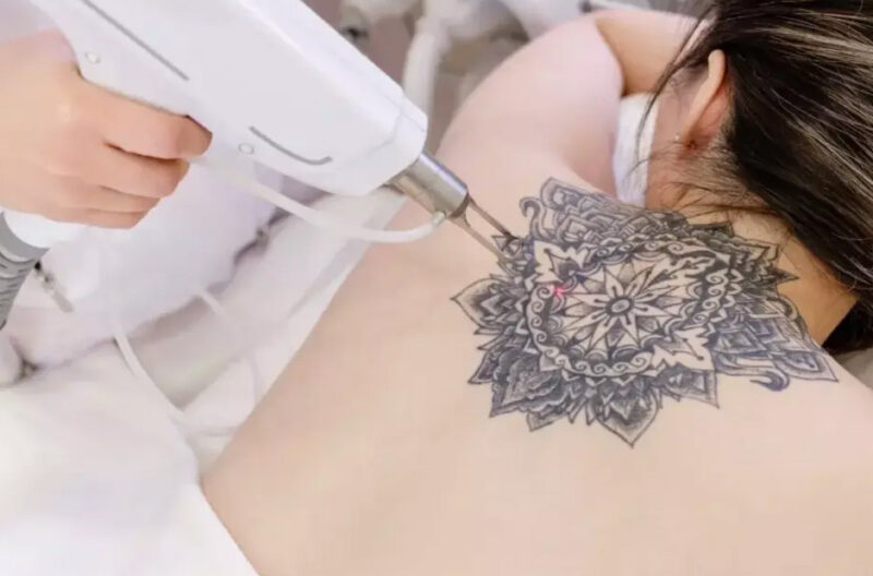 The Ultimate Guide to Tattoo Removal in 2026