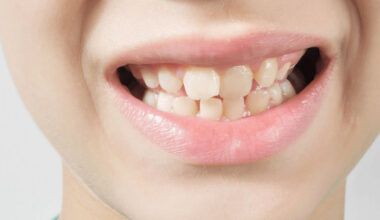 Top Signs You Might Need Orthodontic Care In Johns Creek