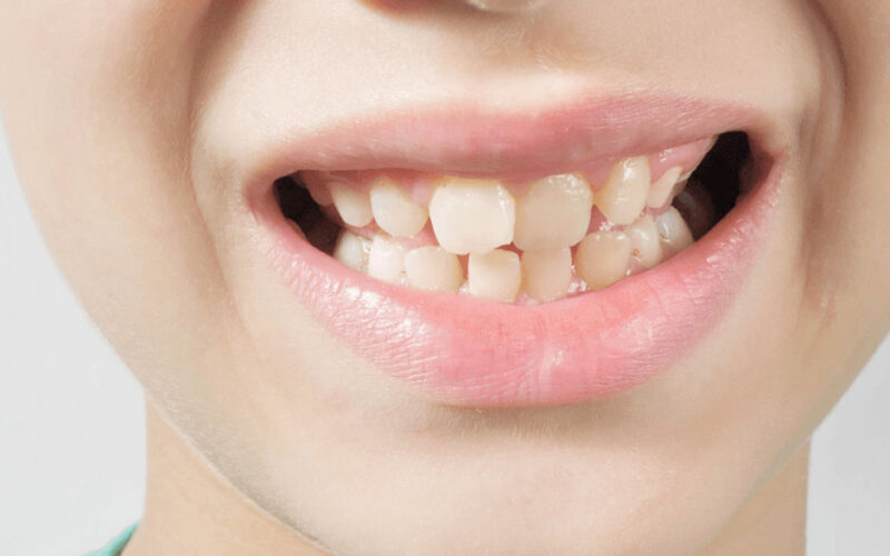 Top Signs You Might Need Orthodontic Care In Johns Creek