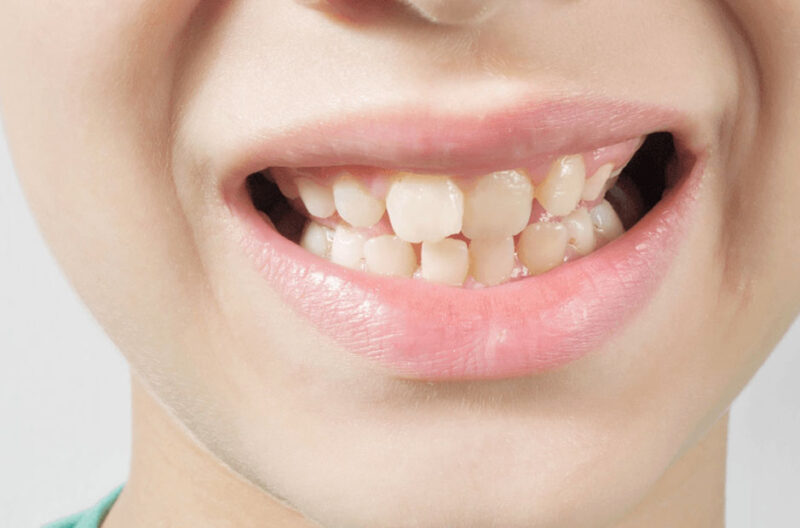 Top Signs You Might Need Orthodontic Care In Johns Creek