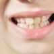 Top Signs You Might Need Orthodontic Care In Johns Creek