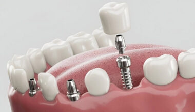 Are Dental Implants the Best Solution for Missing Teeth