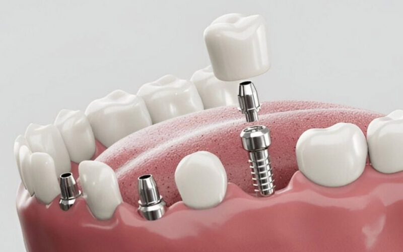 Are Dental Implants the Best Solution for Missing Teeth