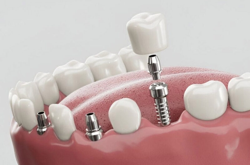 Are Dental Implants the Best Solution for Missing Teeth