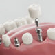 Are Dental Implants the Best Solution for Missing Teeth