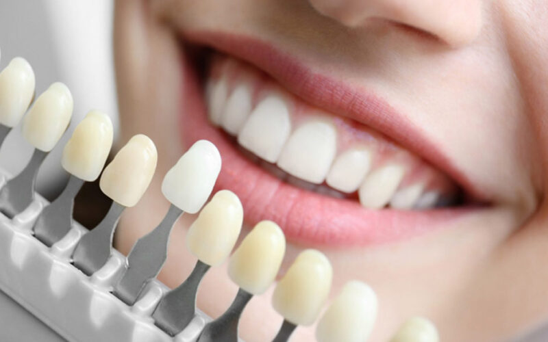 Key Reasons to Choose Dental Implants