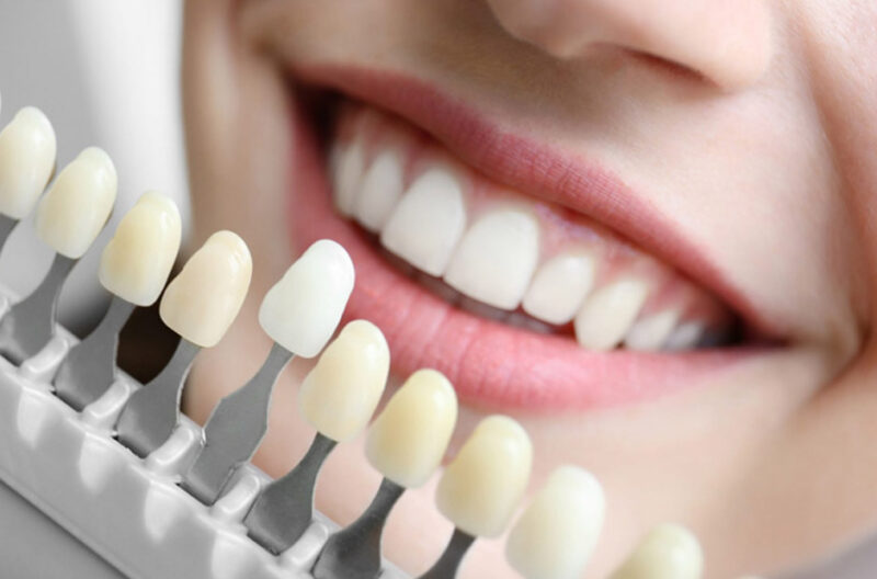 Key Reasons to Choose Dental Implants