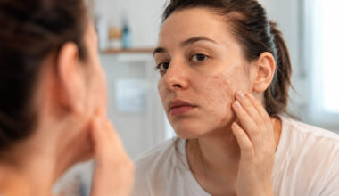 What Happens if Acne Scars Are Left Untreated