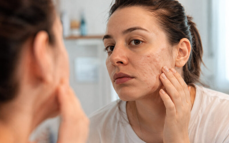 What Happens if Acne Scars Are Left Untreated