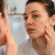 What Happens if Acne Scars Are Left Untreated